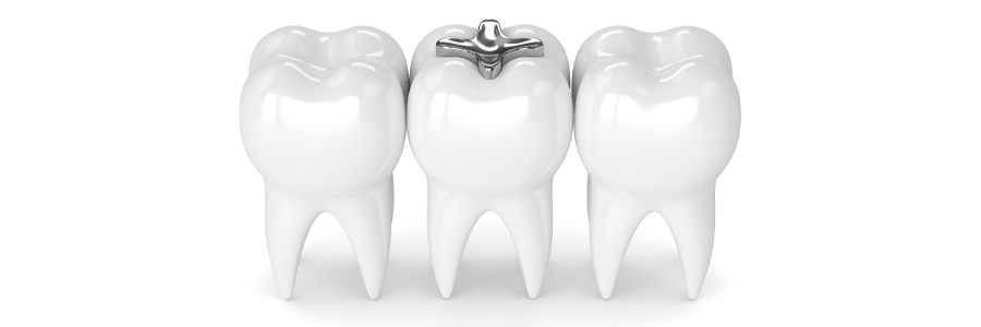 silver amalgam fillings with mercury in it on a tooth