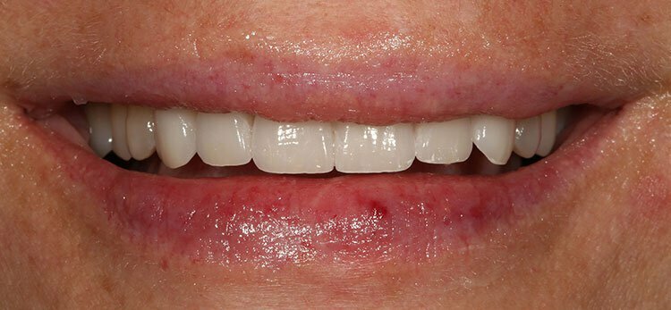 After Full Mouth Reconstruction after