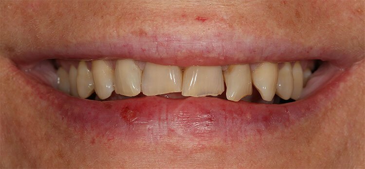 Porcelain Veneers vsTeeth Whitening