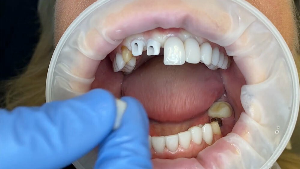 Dental Implant Videos