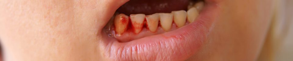 bleeding gums