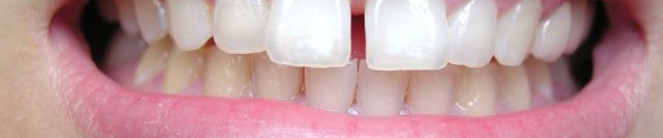 gapped teeth gapped teeth