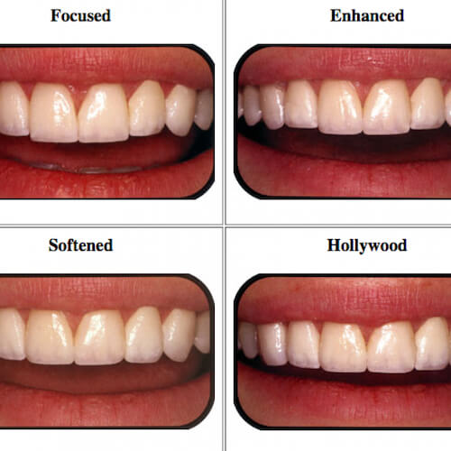 Porcelain Veneer Types 2