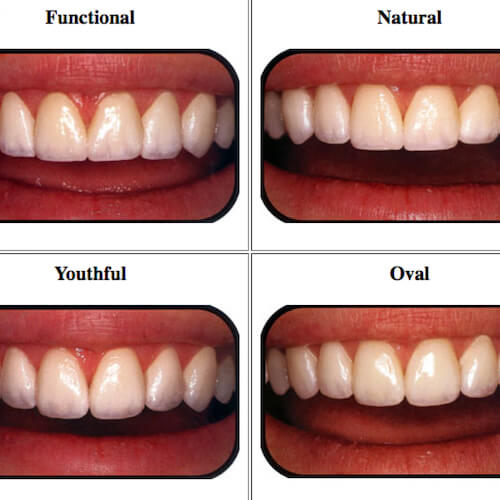 How to Choose the Best Veneers for Your Face Shape - Functional Catalog