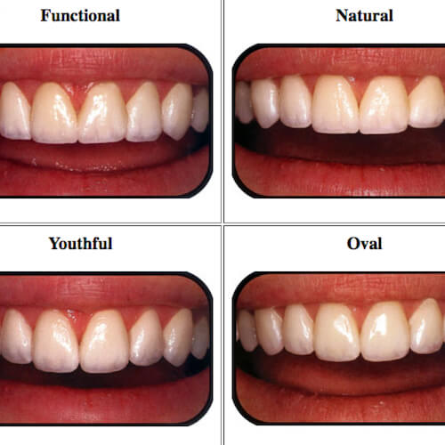 Porcelain Veneer Types 3