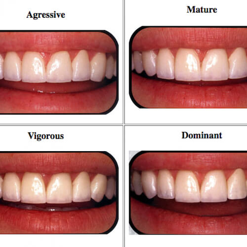 Porcelain Veneers Color Chart