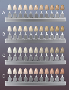 porcelain veneer tooth colors