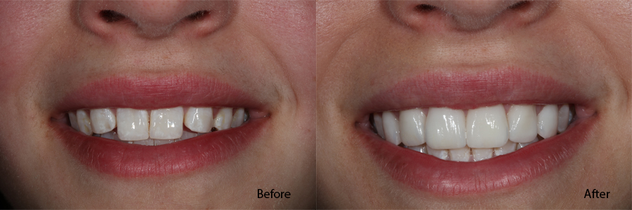 porcelain veneers