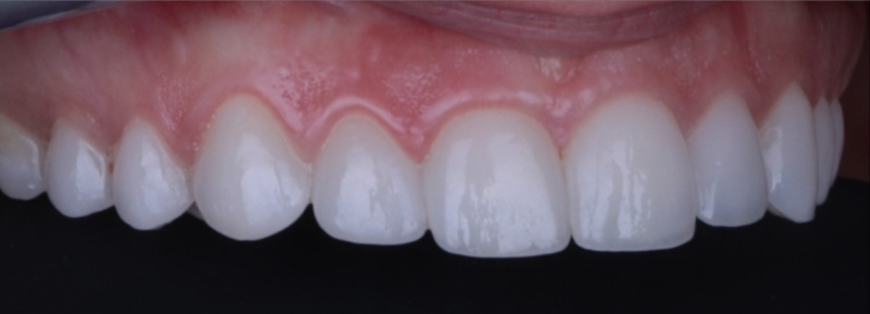 NuVeneers<sup>®</sup> Before & After Photo