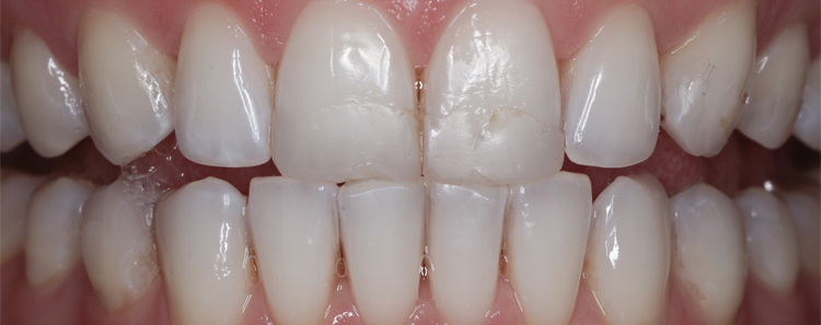 NuVeneers<sup>®</sup> Before & After Photo