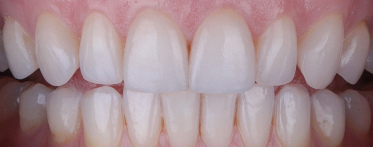 NuVeneers<sup>®</sup> Before & After Photo