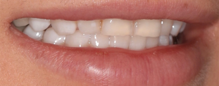 NuVeneers<sup>®</sup> Before & After Photo