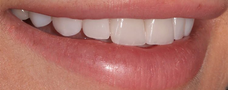 NuVeneers<sup>®</sup> Before & After Photo