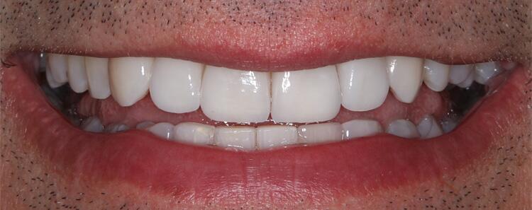 NuVeneers<sup>®</sup> Before & After Photo