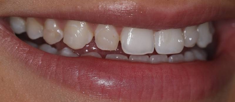 NuVeneers<sup>®</sup> Before & After Photo