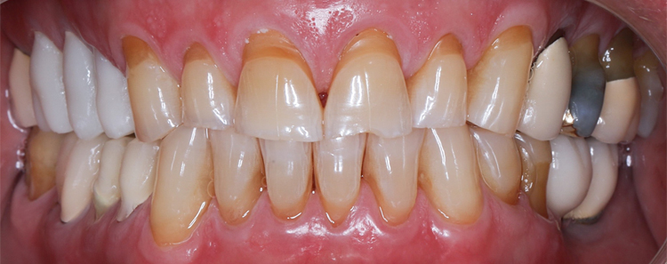 Veneers Before & After Photo