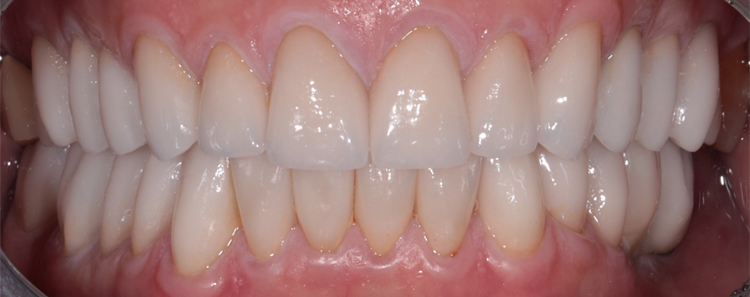 Veneers Before & After Photo