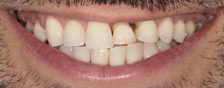 Veneers Before & After Photo