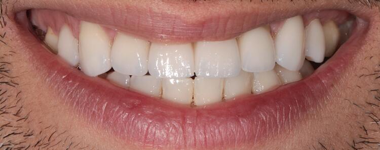 Veneers Before & After Photo