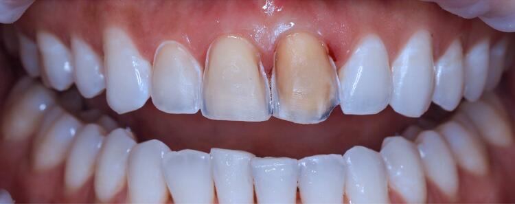 Veneers Before & After Photo