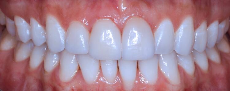 Veneers Before & After Photo