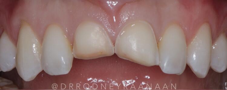 Veneers Before & After Photo