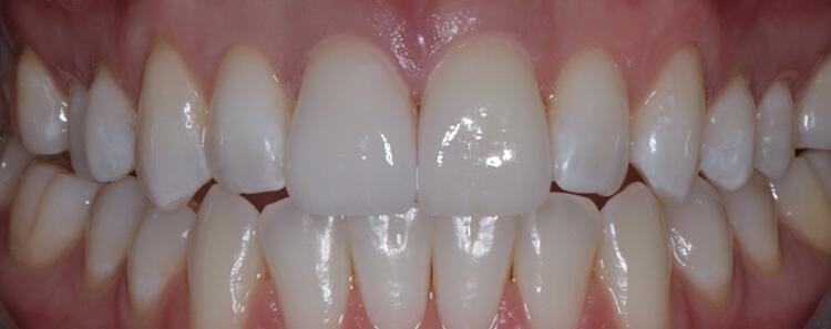 Veneers Before & After Photo