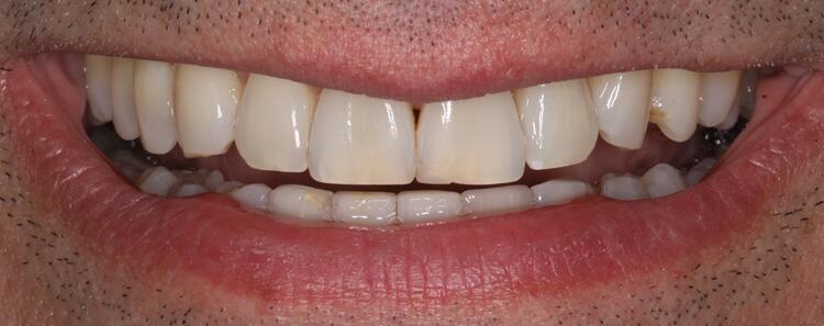 NuVeneers<sup>®</sup> Before & After Photo