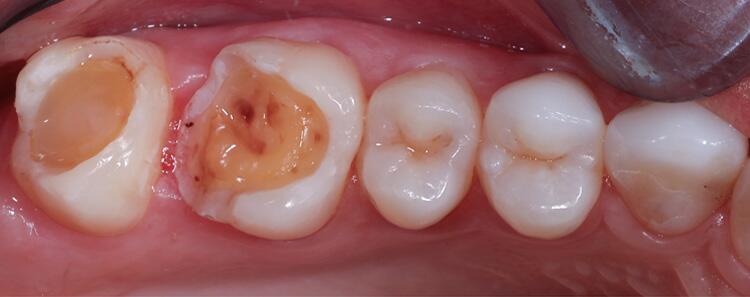 Inlays Before & After Photo