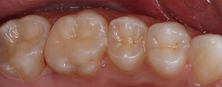 Inlays Before & After Photo