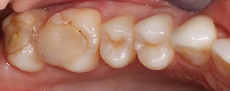 Inlays Before & After Photo