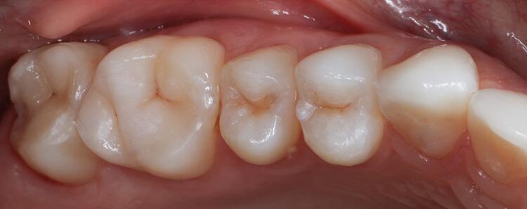 Anterior Crowns Before & After Photo