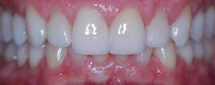 NuVeneers<sup>®</sup> | Full Mouth Reconstruction Before & After Photo