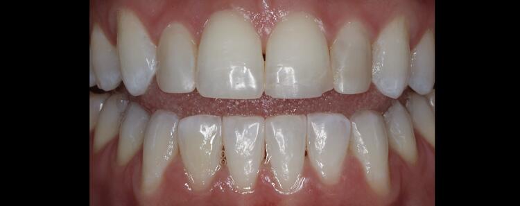 Anterior Crowns Before & After Photo