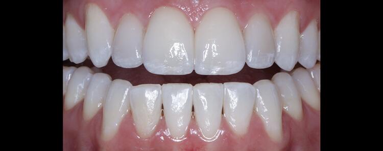 Anterior Crowns Before & After Photo