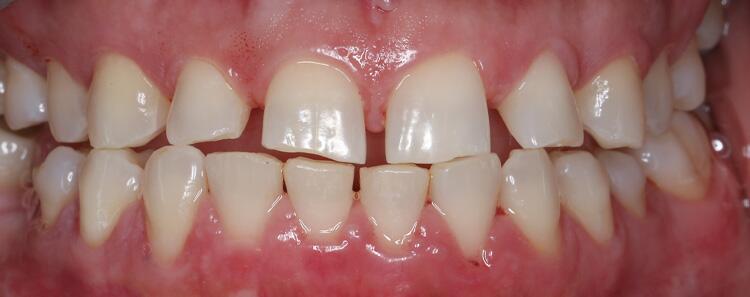 Anterior Crowns Before & After Photo