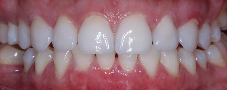 Anterior Crowns Before & After Photo