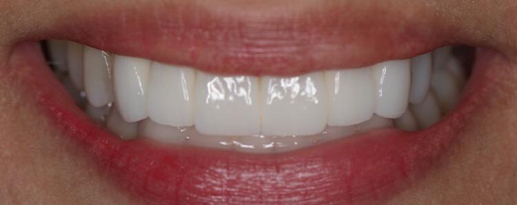 Anterior Crowns Before & After Photo