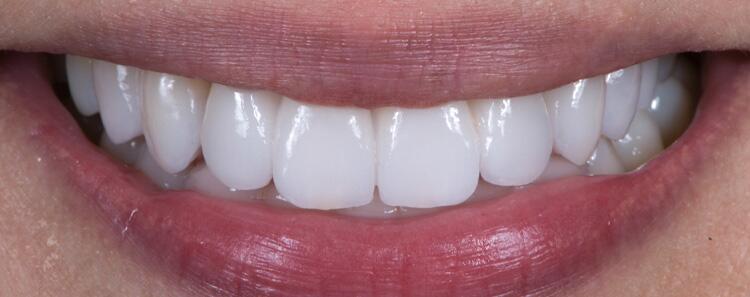 Anterior Crowns Before & After Photo