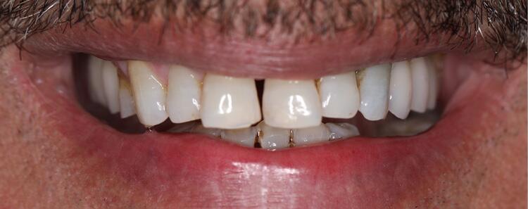 Anterior Crowns Before & After Photo