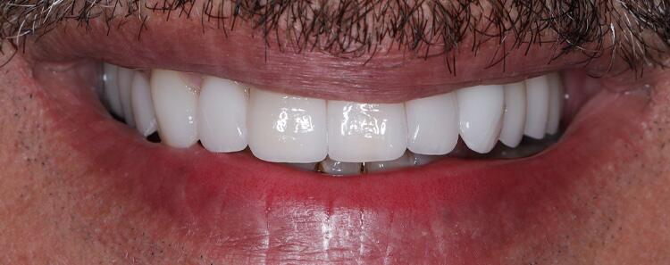Anterior Crowns Before & After Photo