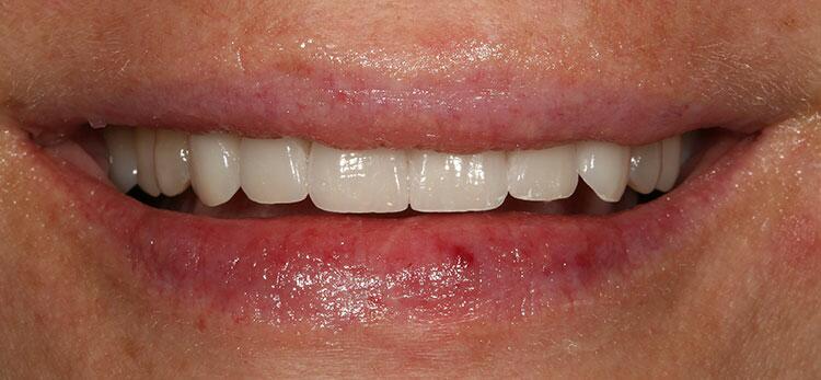 Porcelain Veneers Before & After Photo