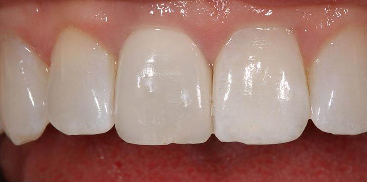 Veneers Before & After Photo