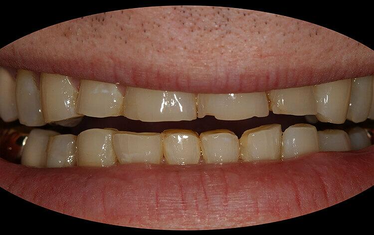 Veneers Before & After Photo