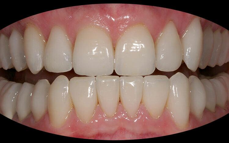 Veneers Before & After Photo