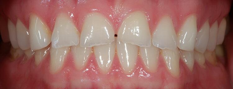 Veneers Before & After Photo