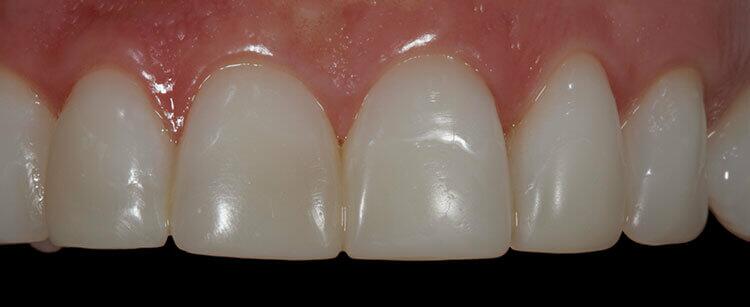 Veneers Before & After Photo