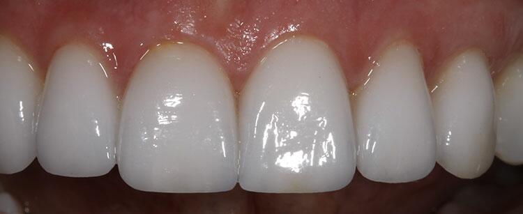 Veneers Before & After Photo