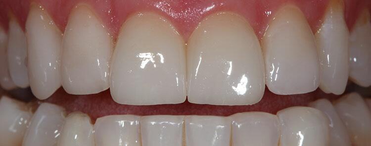 Veneers Before & After Photo