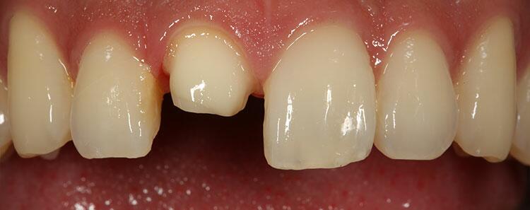 Tooth Restoration Before & After Photo